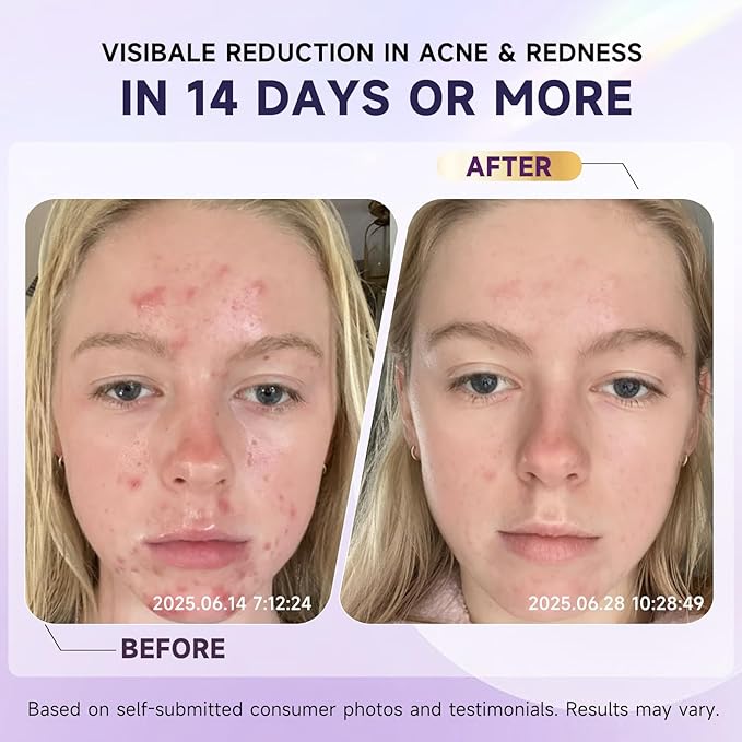 Acne Pimple Spot Treatment Cream with Azelaic Acid 10% – for Stubborn, Cystic & Hormonal Acne, Blackheads | Redness Reducing, Brightening Skincare Moisturizer for Rosacea & Sensitive Skin, 1.7 oz